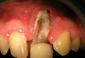 Osteomijelitis nakon vađenja zuba